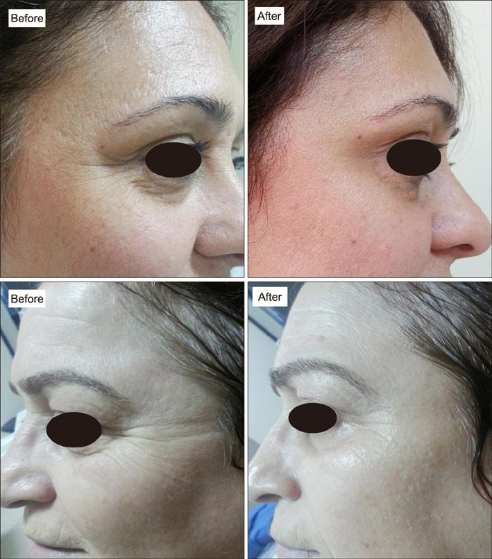 ฟื้นฟูด้วยเกล็ดเลือดเข้มข้นชนิดฉีด R.P.R – โซนหน้า